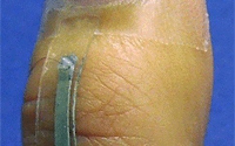 一个基于银纳米线的传感器被安装在拇指关节上，以监测与拇指弯曲相关的皮肤张力。该传感器具有良好的耐磨性和大应变传感能力